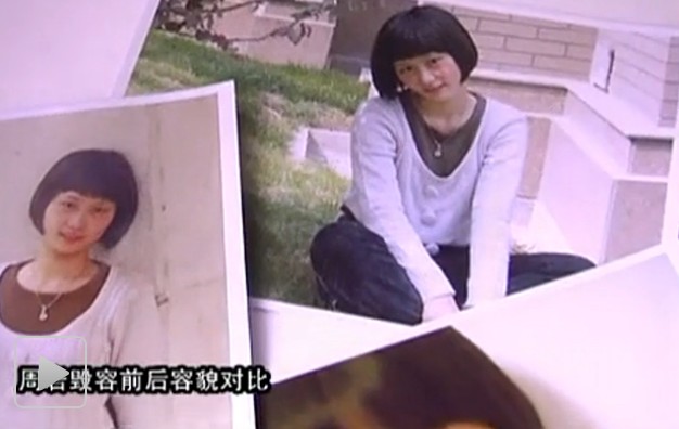 17岁少女戴面具讲诉被90后男生烧伤始末